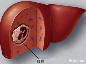 患癌肝被肿瘤占近半（弥漫性肝病变是癌症吗？）