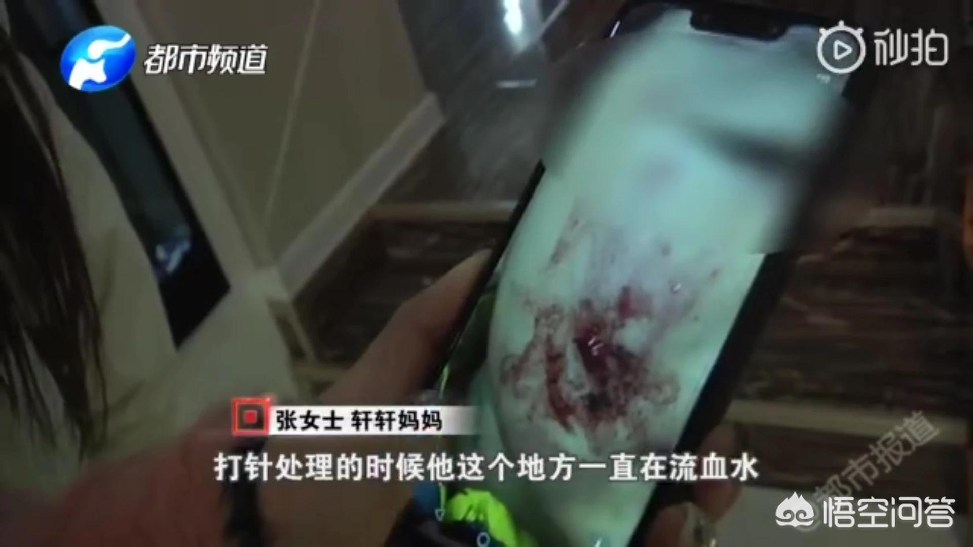 乘电梯被狗扑咬出血（被别人宠物狗在电梯里舔到了伤口，应该怎么办？）