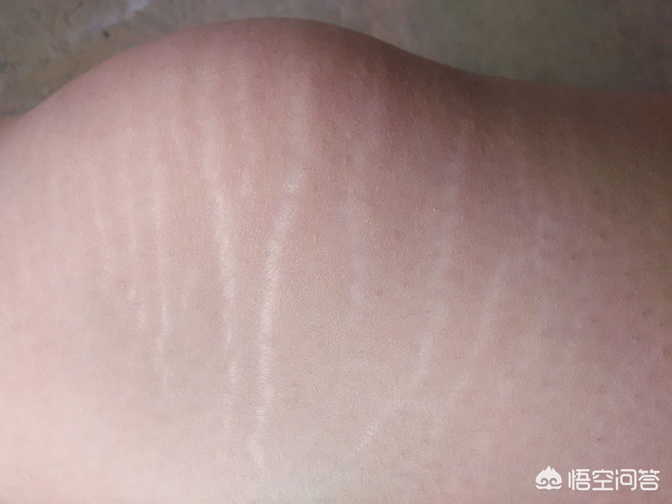 12岁女孩体内长头发（小孩子长身体时，大腿出现横条纹，这是怎么回事？）