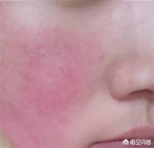 做好4件事预防秋病（秋季，如何避免皮肤刺痛、泛红、紧绷和起皮？）