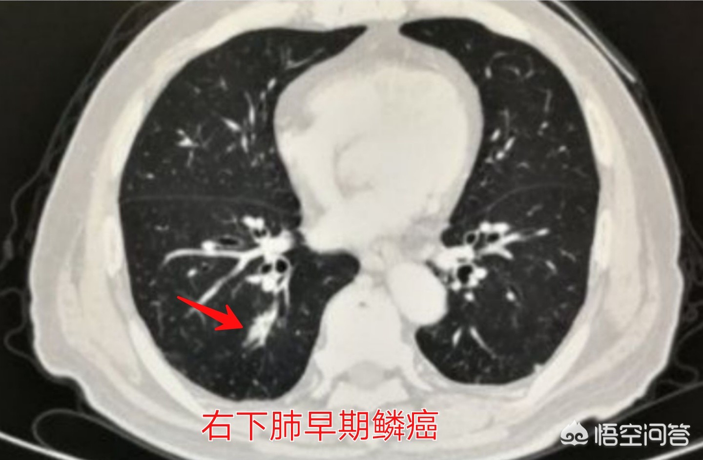 癌症的3种信号