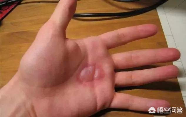 男童被沸水烫伤下肢（云南红河州两男孩在学校被人扒裤子用开水烫伤，你怎么看待此事？）