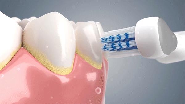 电动牙刷的好处电动牙刷的好处和坏处