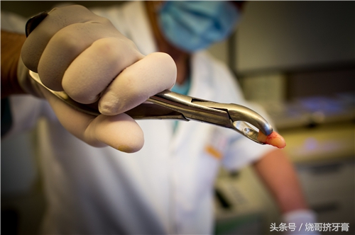 广州市牙周炎洗牙多少钱