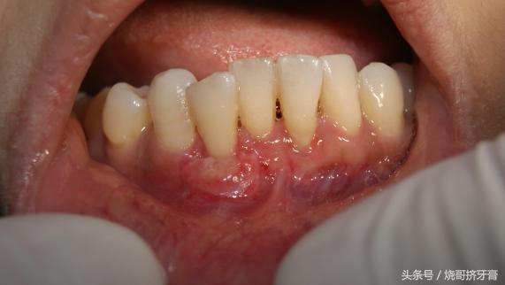 广州市牙周炎洗牙多少钱