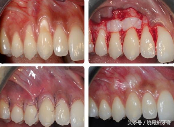广州市牙周炎洗牙多少钱 广州市牙周炎洗牙多少钱
