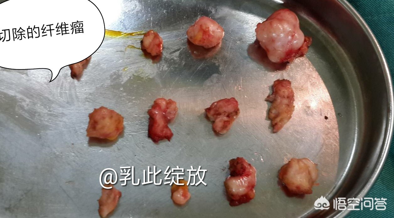 摸到疙瘩确诊乳腺癌（乳腺肿块不一定是乳腺癌，可能是乳腺疾病，两者之间该如何区分？）