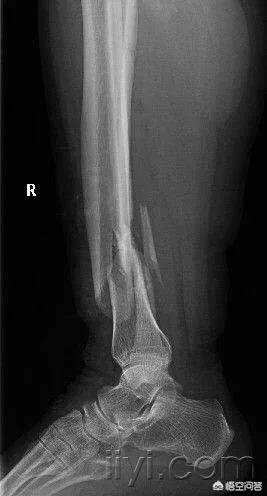 粉碎什么（粉碎什么填空？）