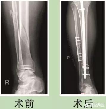 粉碎什么(粉碎什么填空?) 粉碎什么(粉碎什么填空?)