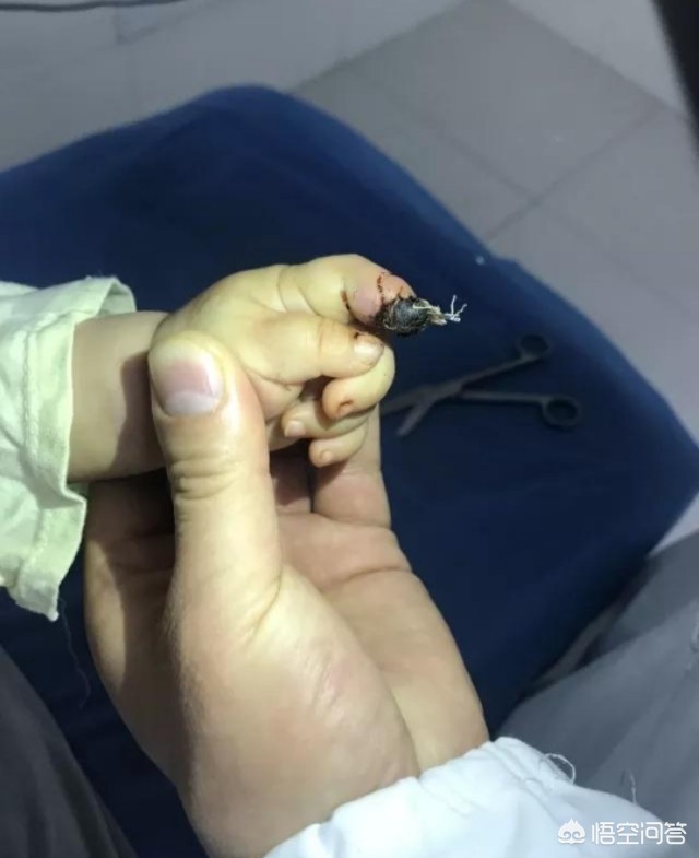 意外受伤百万医疗能赔偿吗？：女童指尖被夹断