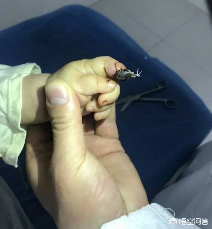 [女童指尖被夹断]一根手指夹断了一小节算几级伤残？