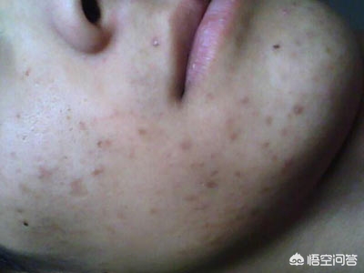 怎样预防青少年青春痘,怎样预防青少年青春痘的发生