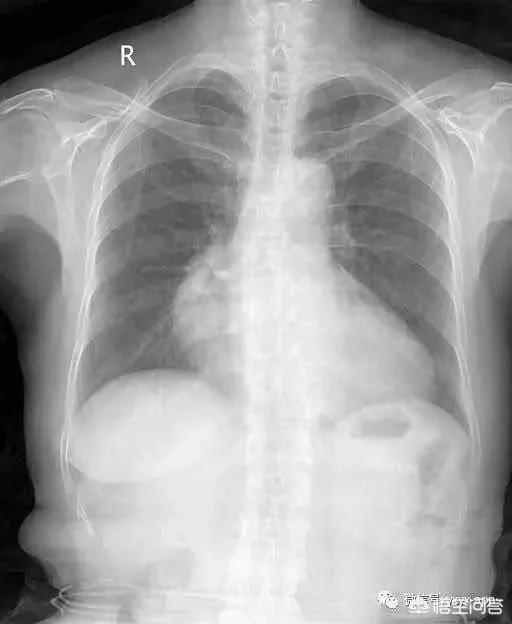 围住神经猫（右胸部痛一周左右，可能是怎么回事？）