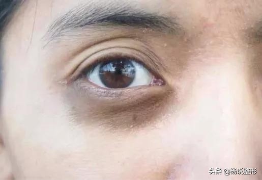 [黑眼圈眼霜]哪种眼霜去黑眼圈好？