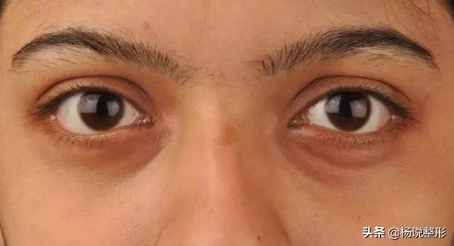 [黑眼圈眼霜]哪种眼霜去黑眼圈好？