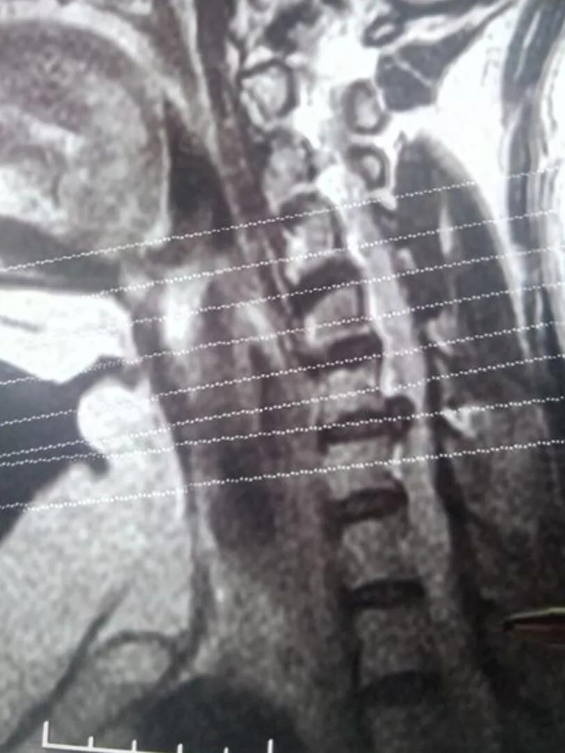 男演员确诊不死癌症（焦虑症和抑郁症俗称不死癌症是吗？）