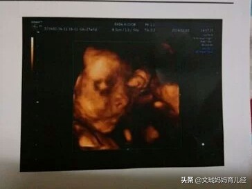 为什么做四维彩超，看不见小孩的脸，该怎么办？：结婚5年未见对方脸