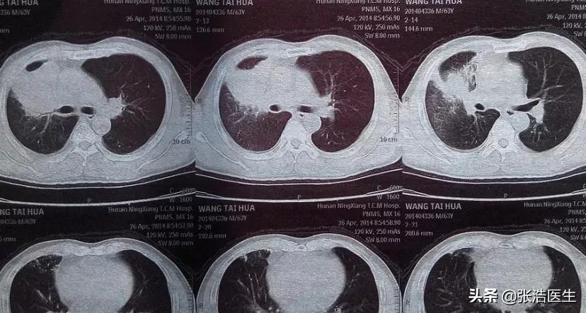弄错CT图像致误诊ct误诊怎么办
