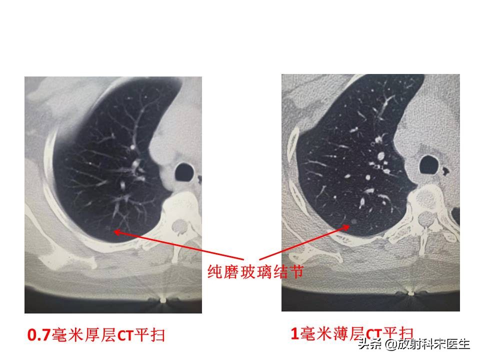 [弄错CT图像致误诊]一个月前在医院查出肺癌，住院后发现被误诊了，我可以告医院吗？