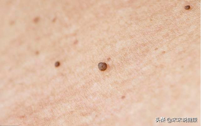 专家，女性感染hpv病毒症状有哪些？：8成女性感染过HPV