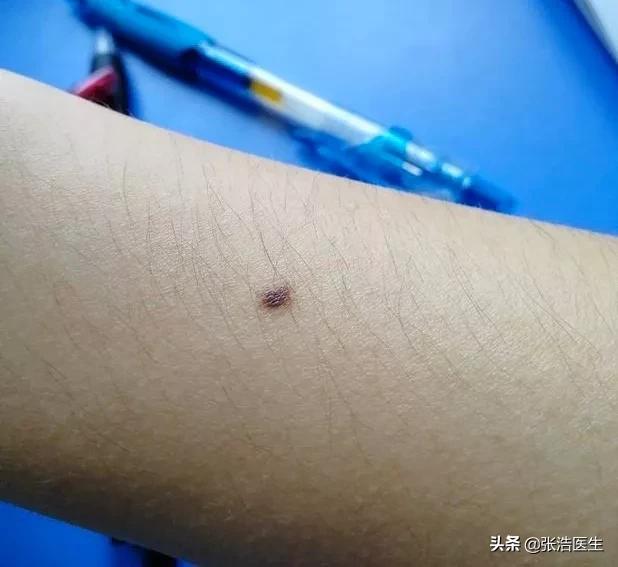[癌症的3种信号]身上哪些部位的黑痣需要警惕，可能是癌症的信号？