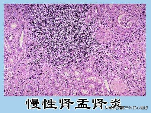 [女大学生尿毒症晚期]肾盂肾炎晚期发展成尿毒症要乡久？