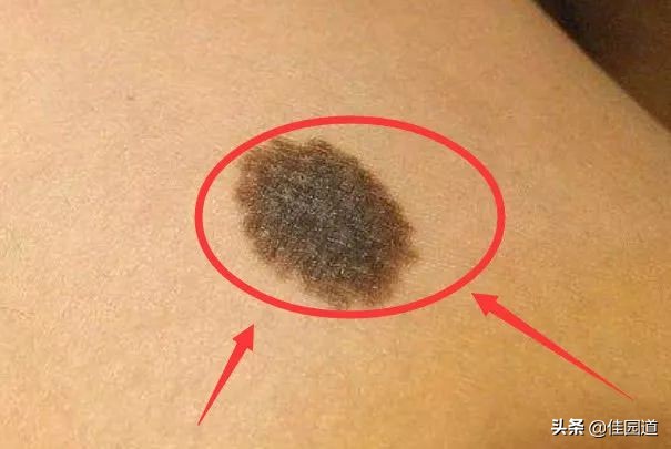 [癌症的3种信号]两手臂酸痛是早期癌症的信号吗？