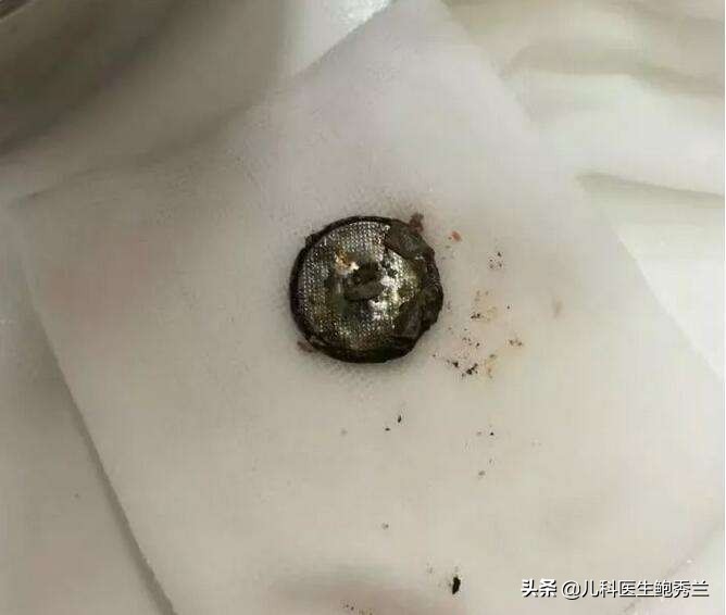 误吞电池3天后排出（小孩吃了纽扣电池能拉出来吗？）