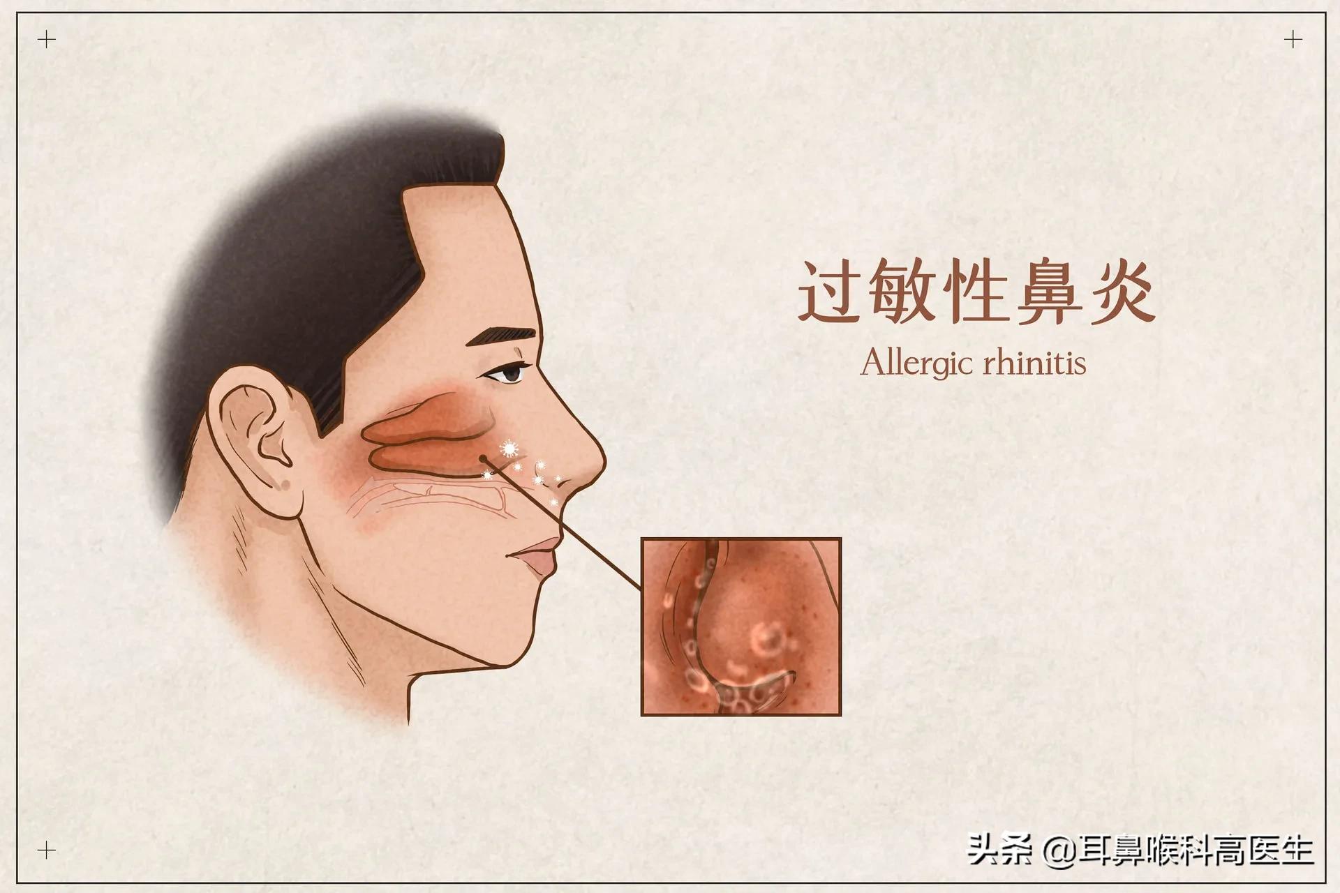 过敏性鼻炎最佳治疗方法方法有哪些?:过敏性鼻炎 过敏性鼻炎最佳治疗方法方法有哪些?:过敏性鼻炎