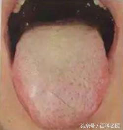 舌苔变黑是得了重病吗？舌头出现这5种症状的要小心了！