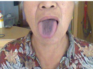 舌苔变黑是得了重病吗？舌头出现这5种症状的要小心了！