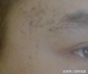 眼角长斑是什么原因引起的？中医说：太阳穴长斑的人易抑郁！