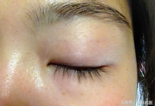 眼角长斑是什么原因引起的？中医说：太阳穴长斑的人易抑郁！