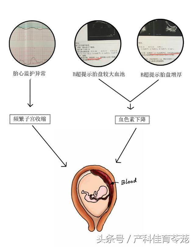 什么叫胎盘早剥?（危及妈妈和宝宝生命的胎盘早剥）