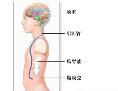治疗脑积水的方法是什么（脑积水怎么治疗最好）