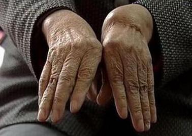 花胶洗澡能治类风湿吗 2026年花胶泡脚好吗 花胶洗澡能治类风湿吗 2026年花胶泡脚好吗