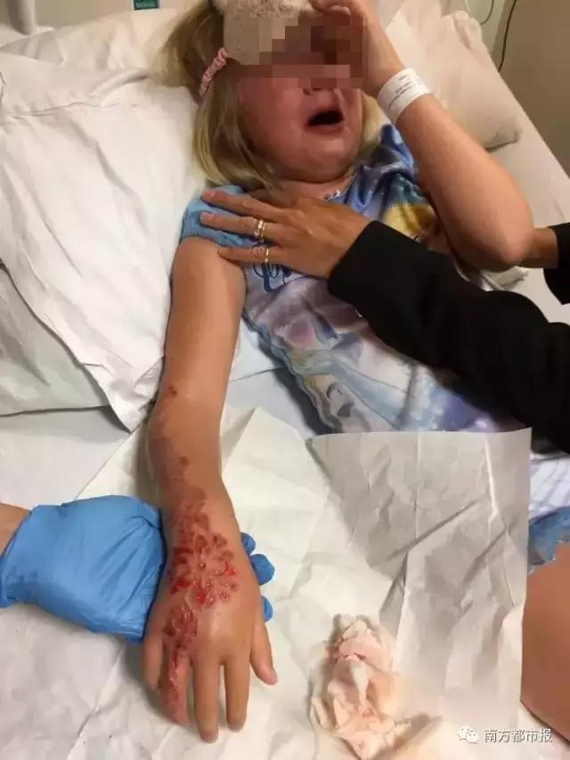 很多人爱玩的临时纹身出事了！女孩涂后出疹起水泡留疤，惨不忍睹