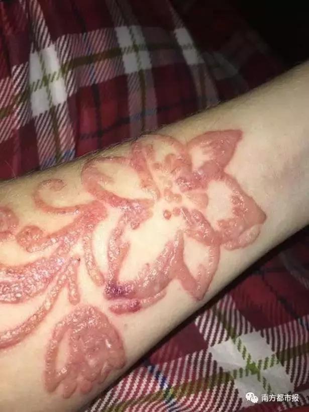 很多人爱玩的临时纹身出事了！女孩涂后出疹起水泡留疤，惨不忍睹