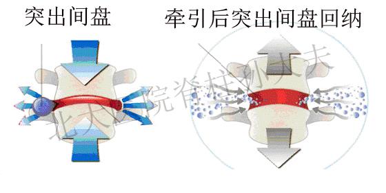 腰椎间牵引方法（腰椎间盘突出症患者的自我救赎牵引篇）