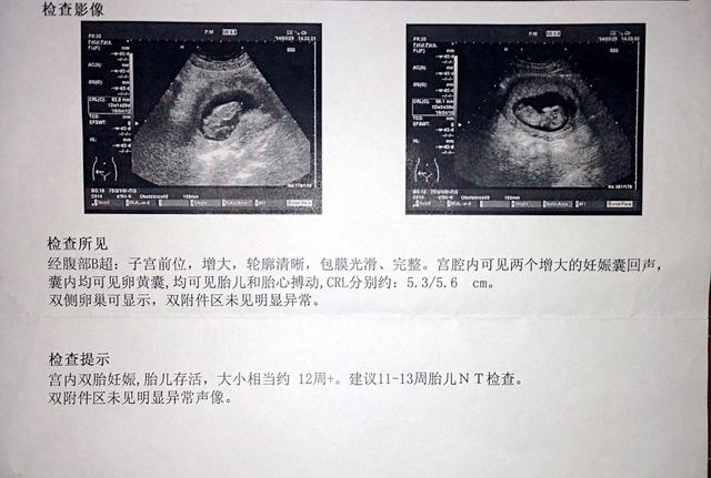 姐姐怀双胞胎惊魂记，羊水栓塞差点母子不保。