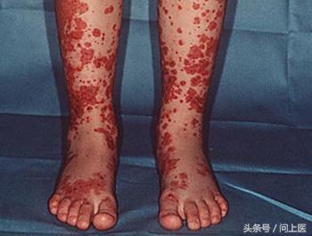 不同类型的血管炎症状有什么不同？该如何治疗和用药？