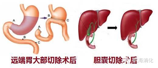 睡姿与消化疾病