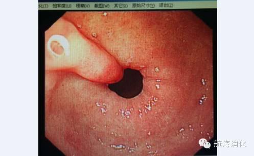 睡姿与消化疾病