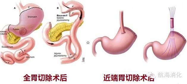 睡姿与消化疾病