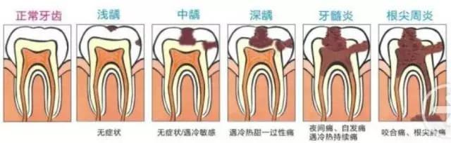 牙神经疼怎么办？