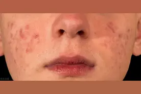 不同部位长痘痘，代表不同内脏有问题？从中医的角度这么看图片