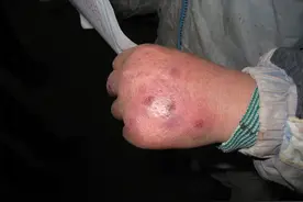 这个冬天很“流氓”，一言不合就开挂，有冻疮的孩子表示伤不起图片