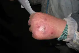 这个冬天很“流氓”，一言不合就开挂，有冻疮的孩子表示伤不起图片