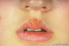 嘴上长“泡”仅仅是因为上火？医生说这“泡”不只是长在嘴边图片