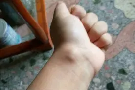 手腕这个位置长了个包，用力捏破就能治好？图片